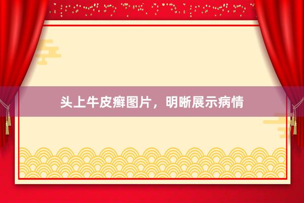 头上牛皮癣图片，明晰展示病情
